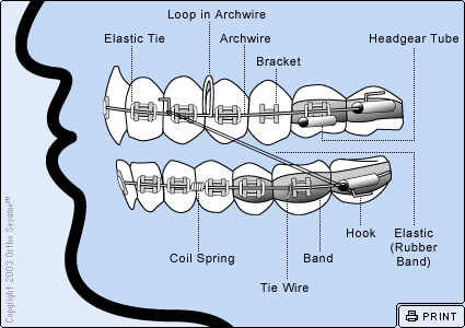 Parts of Your Braces